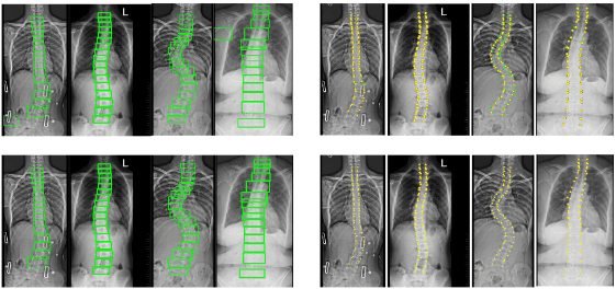 scoliosis-object-landmarks